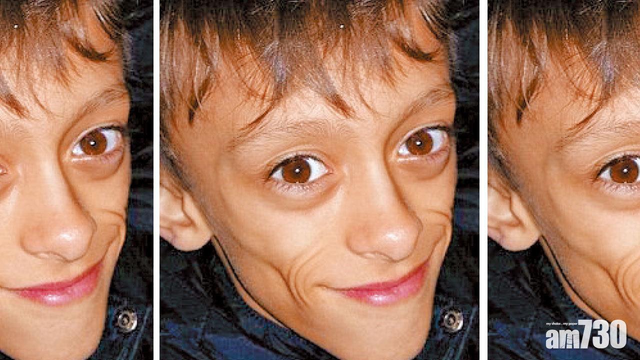 脂肪突消失 男童似阿叔