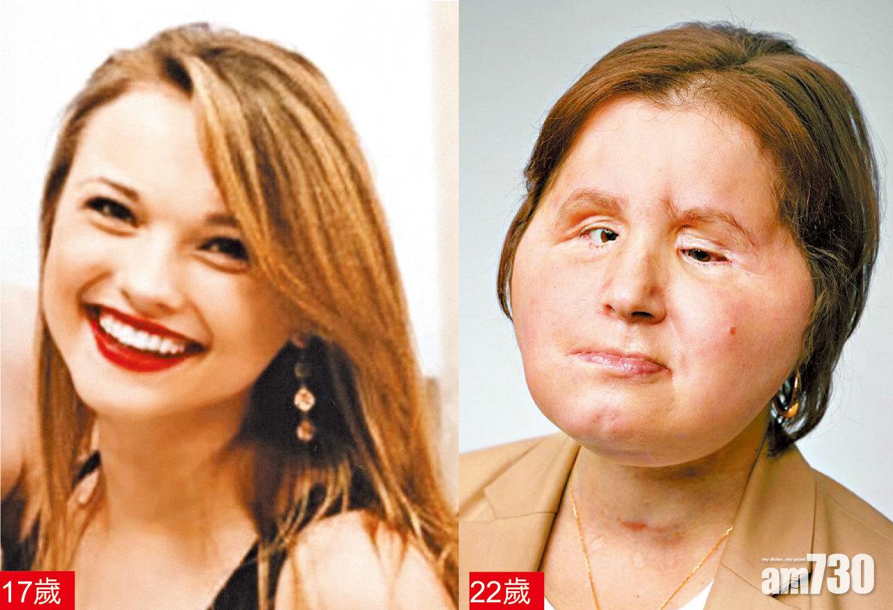 吞槍毀容  少女換臉重生