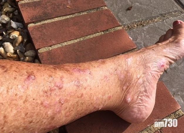 【要靚唔要命】選美皇后曬燈搽可樂 皮膚似85歲兼患癌