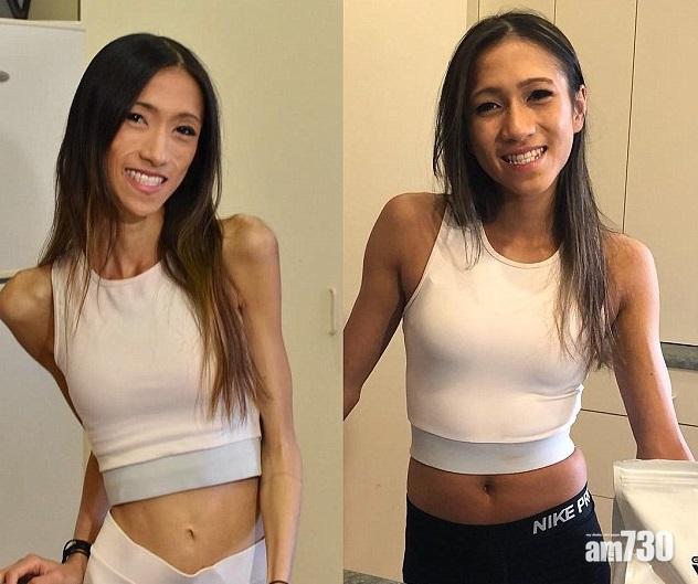 【活骷髏】女醫科生患厭食症 跑步跑到流鼻血