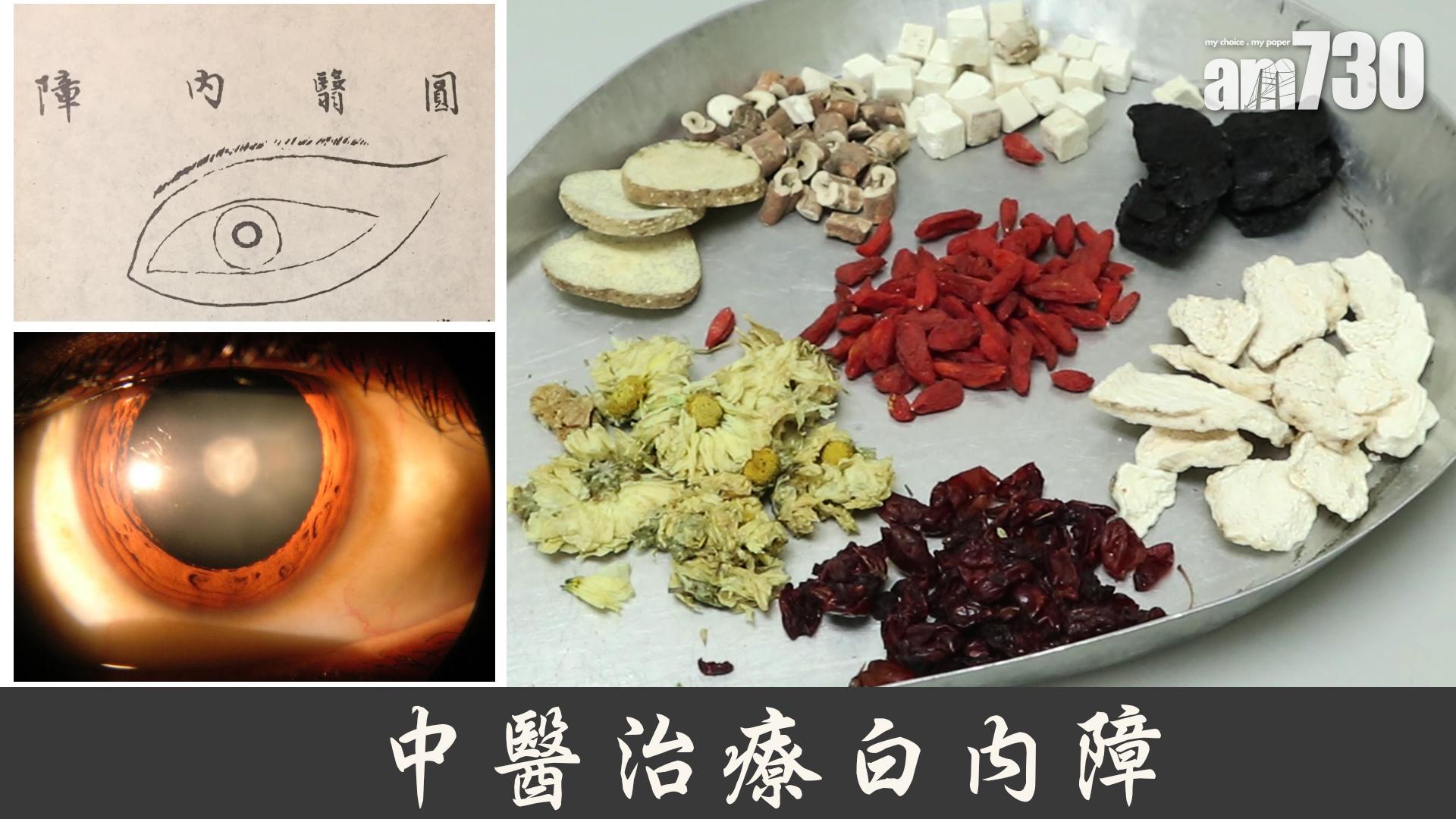 中醫處方延白內障惡化
