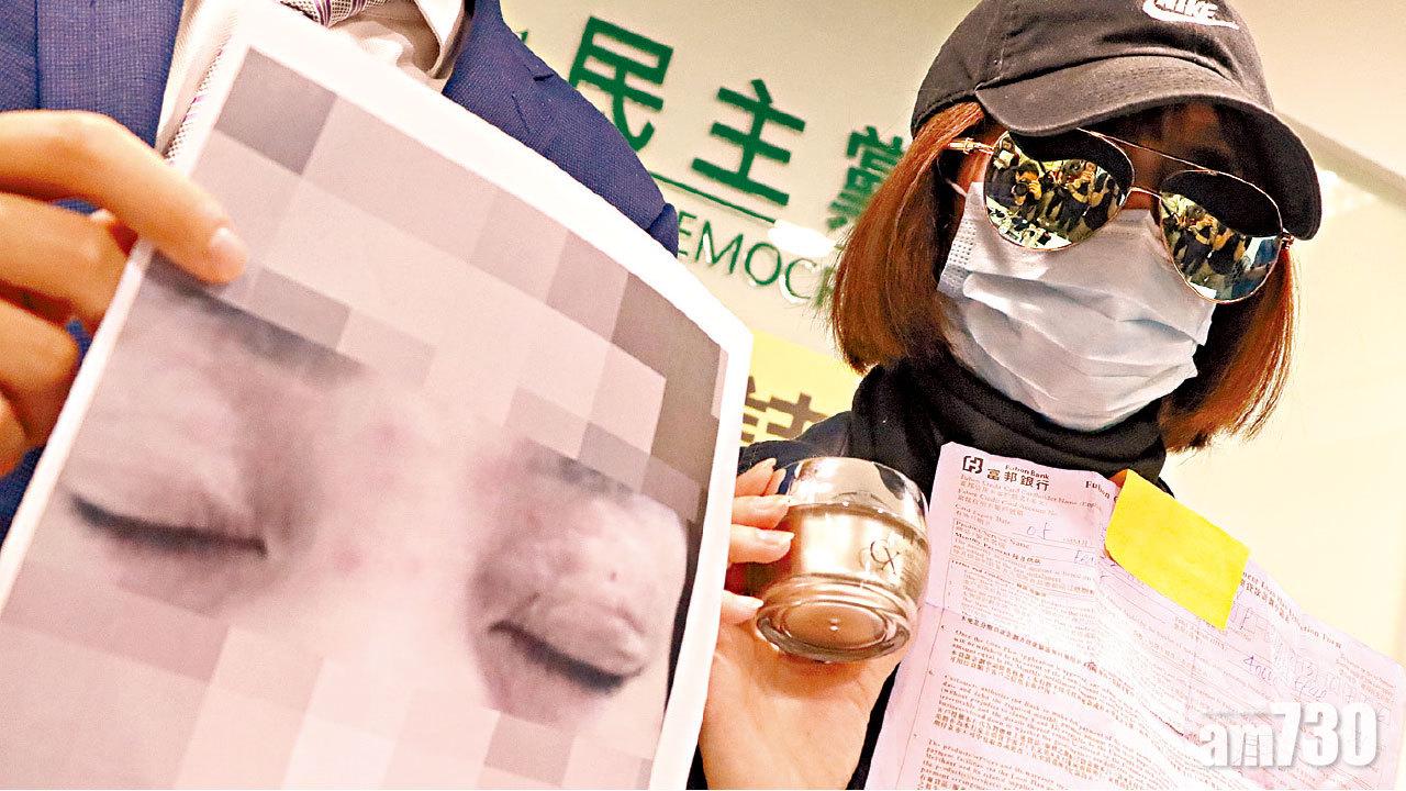 被凱詩職員指有濕疹  購6萬元療程  苦主︰療程致敏感面腫