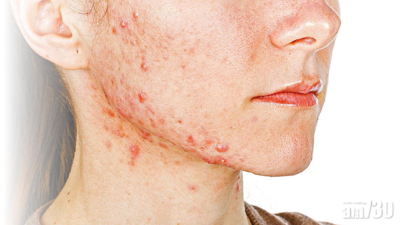 激光治暗瘡 操作不當恐爛面