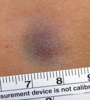 【隱形殺手】女子膊頭現瘀青6年 原來患罕見皮膚癌