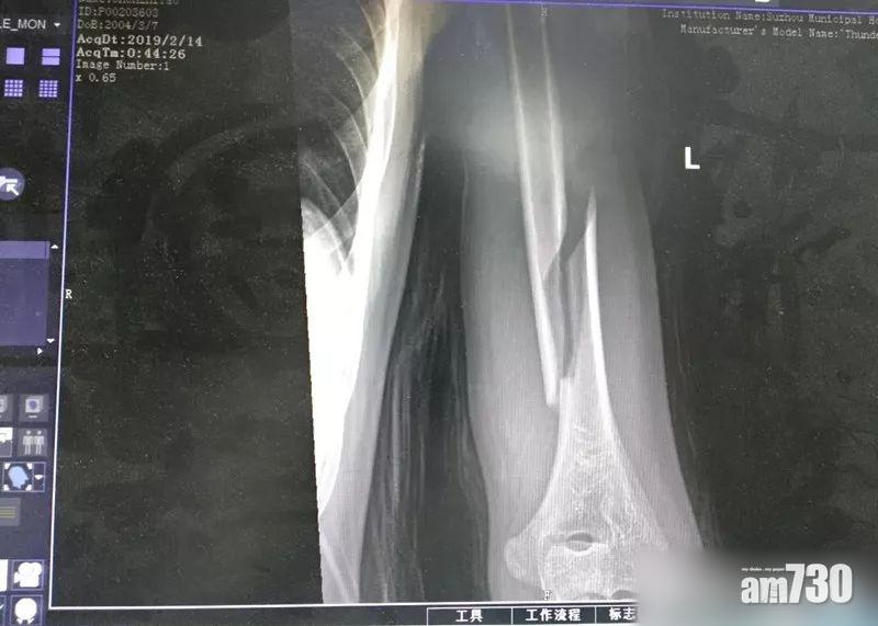 失眠父子拗手瓜 14歲子左臂拗到骨折