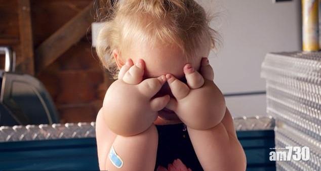 【慘豬】2歲童手腳腫脹似氣球  原來患淋巴水腫