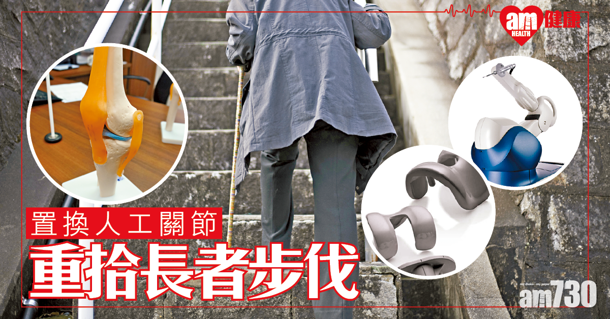 置換人工膝關節 改善退化 恢復活動能力