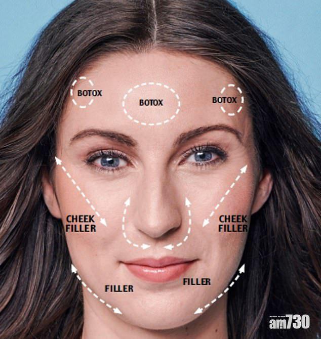 【一針見靚】她的Botox美麗人生