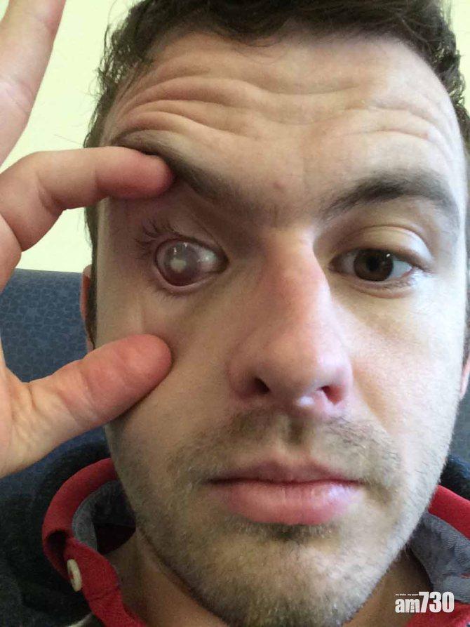 【戴Con注意】青年戴隱形眼鏡沖涼　染寄生蟲需移植角膜