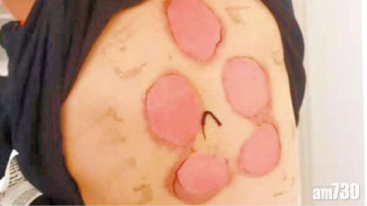 背部紅腫甩皮生水泡  江西92童貼三伏貼灼傷