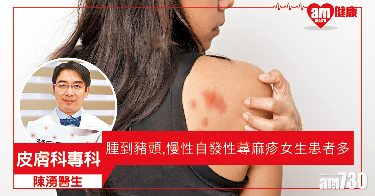 慢性蕁麻疹 可達完全控制