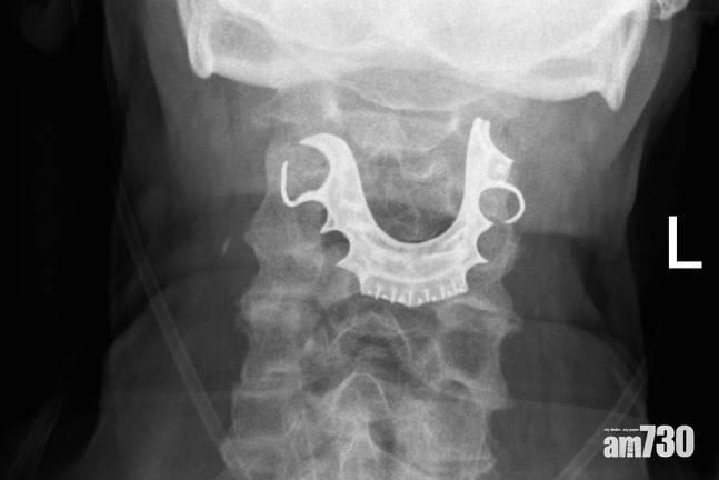 72歲翁手術後吞嚥困難 8日後發現假牙跌入喉嚨 