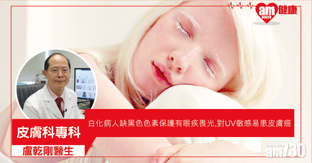 白化病患者首要保護眼睛皮膚