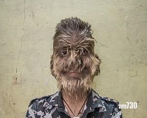 【O晒咀】西班牙16兒童食胃藥變毛孩  原因是……