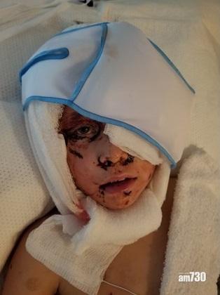 【勇武】8歲仔被美洲獅咬頭拖行  用樹枝機警戳獅眼還擊(有片)