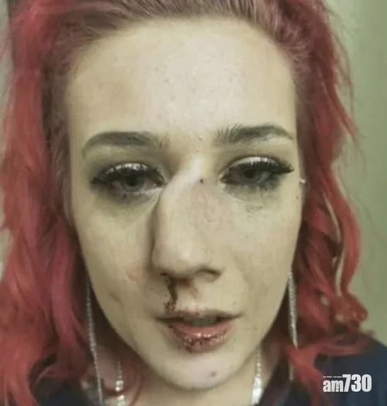 【飛來橫禍】選美後回家遭襲擊　女子鼻骨斷裂變形