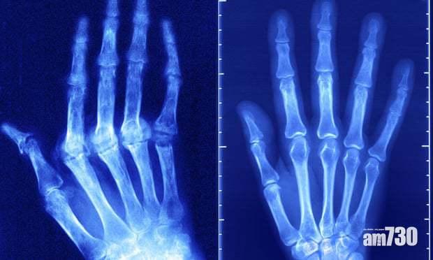 【新發現】美科學家：人體關節軟骨可再生