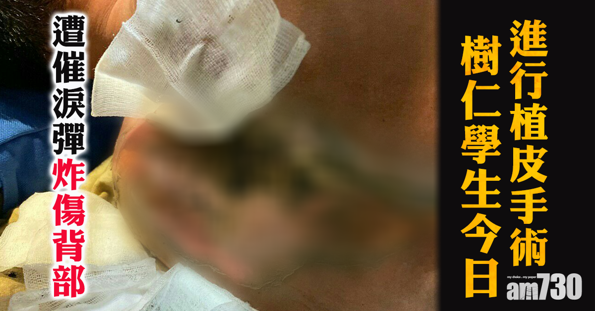遭催淚彈炸傷樹仁學生  今日進行植皮手術
