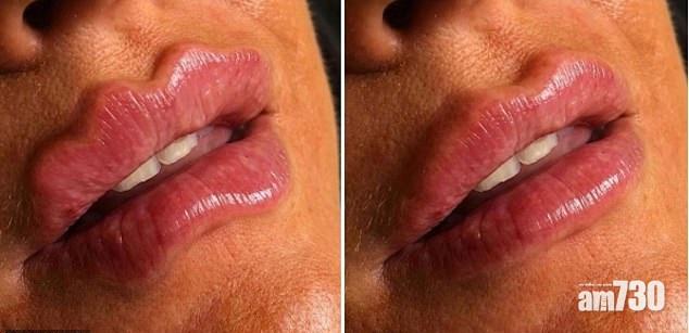 【注射填充劑】潮興魔鬼唇  專家警告小心難復原