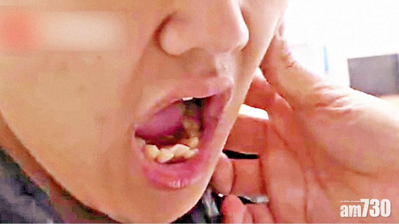 江蘇男笑到合不攏嘴 患下巴關節炎