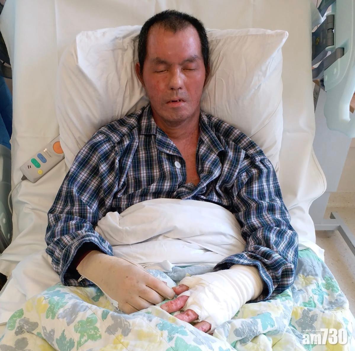 【淋液點火】葛珮帆：燒傷中年漢正排期做第四次植皮手術