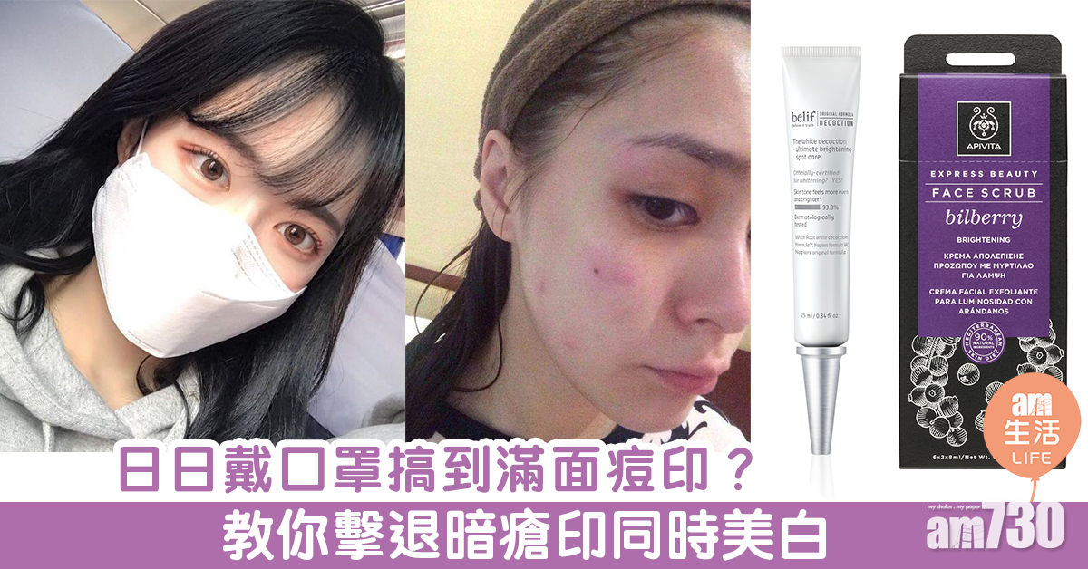 日日戴口罩搞到滿面痘印？ 教你擊退暗瘡印同時美白