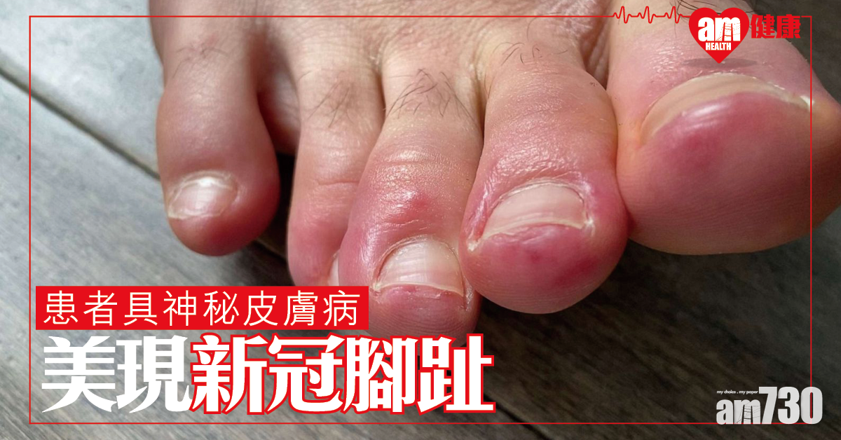 【新冠肺炎】由紅變紫 患者有神秘皮膚病 美國出現「新冠腳趾」