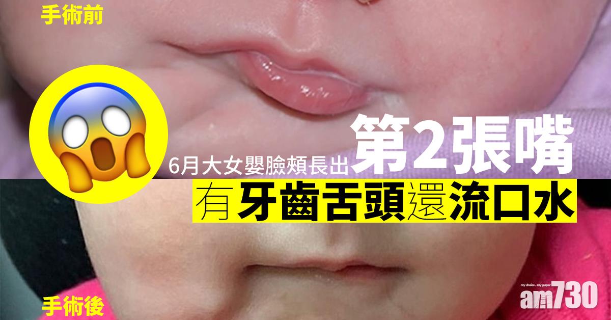 6月大女嬰臉頰長出第2張嘴　有牙齒舌頭還流口水