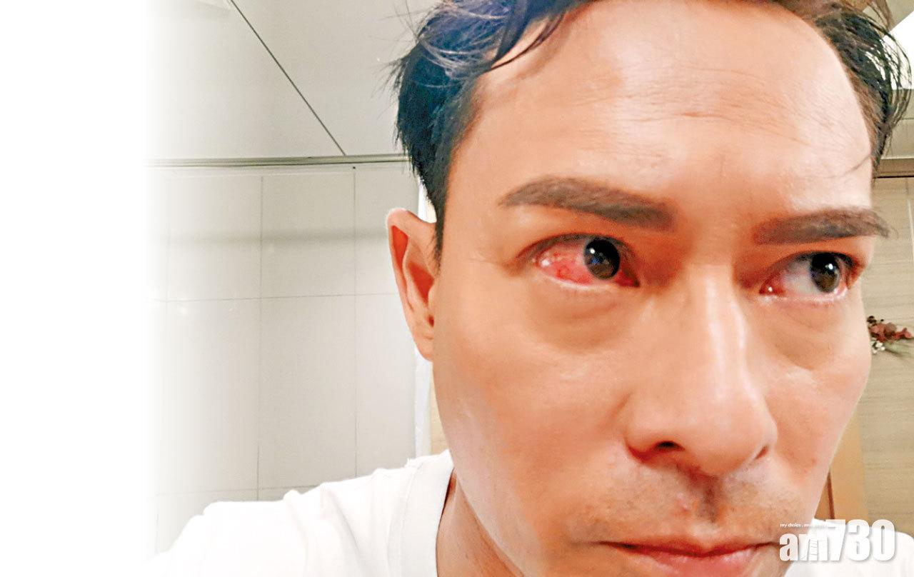 海俊傑拍戲眼角受傷