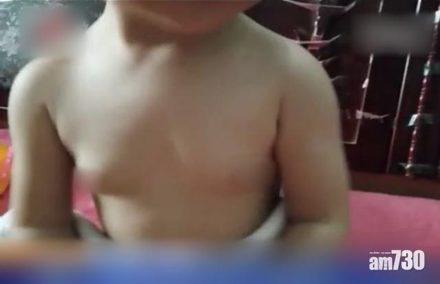 疑飲假奶粉7個月 江西女嬰胸部發育