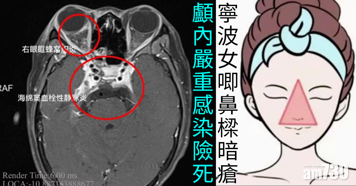 寧波女唧鼻樑暗瘡 顱內嚴重感染險死