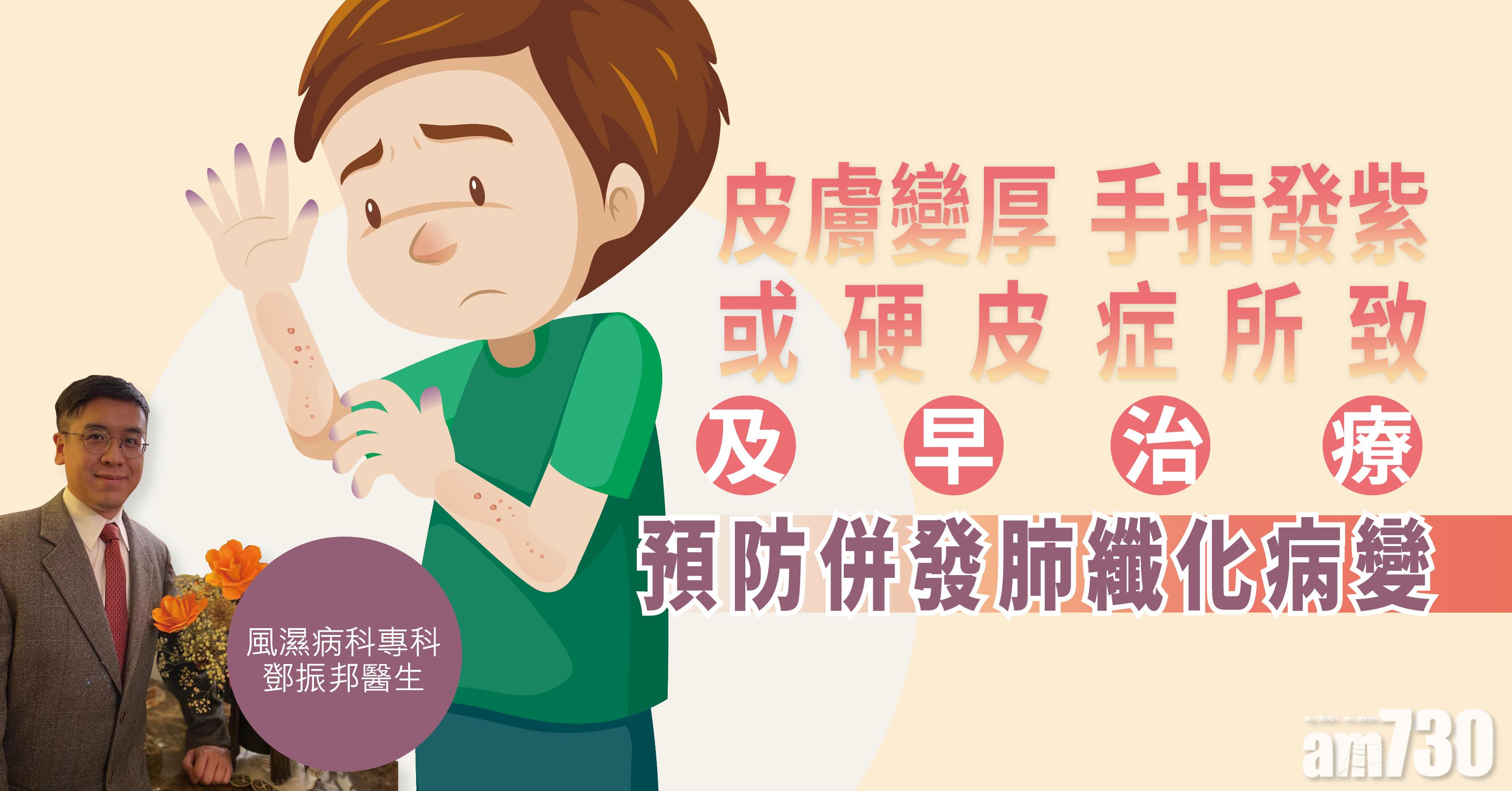 [健康解碼] 皮膚變厚 手指發紫 或硬皮症所致 及早治療 預防併發肺纖化病變