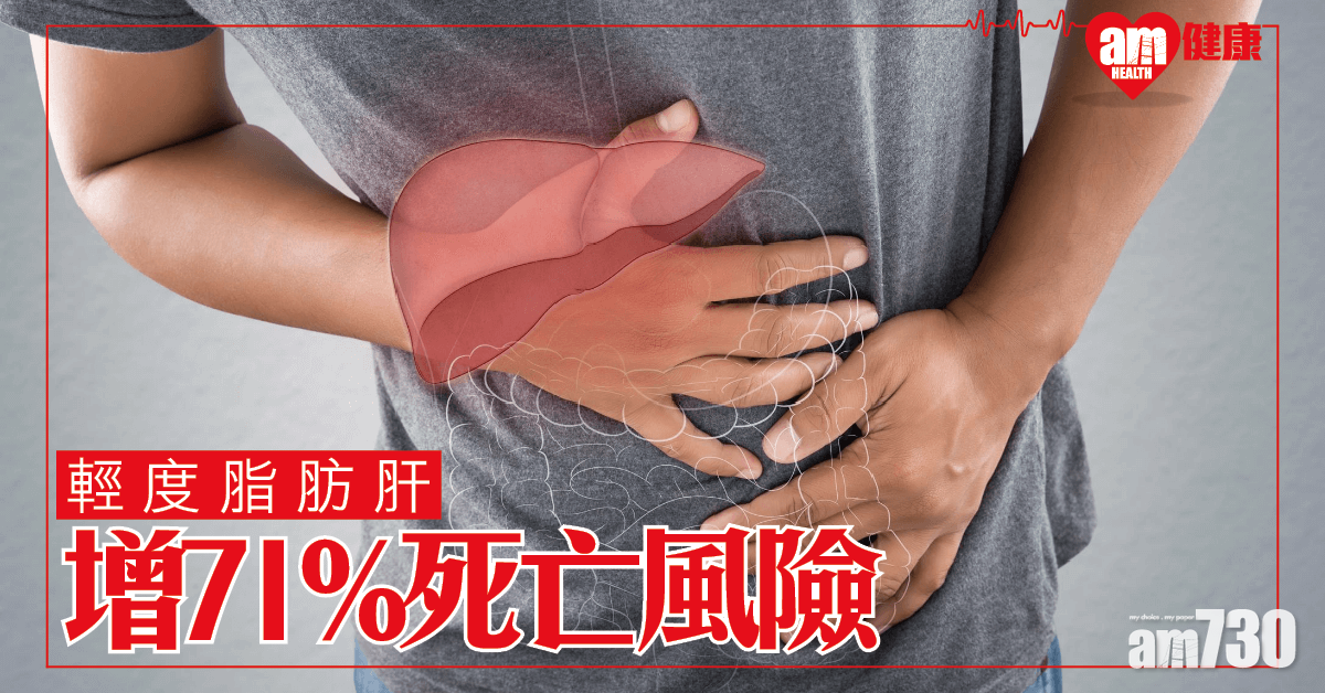 瑞典研究：輕度脂肪肝增71%死亡風險