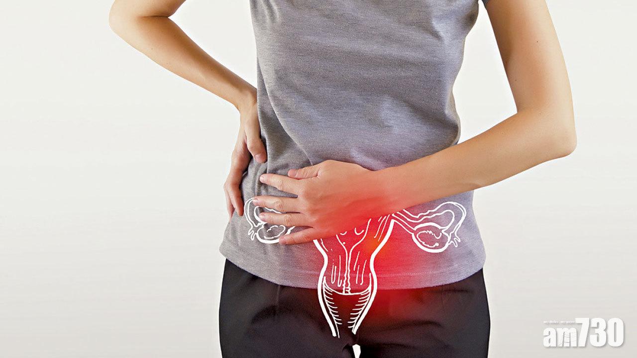 子宮內膜息肉 影響著床致不育