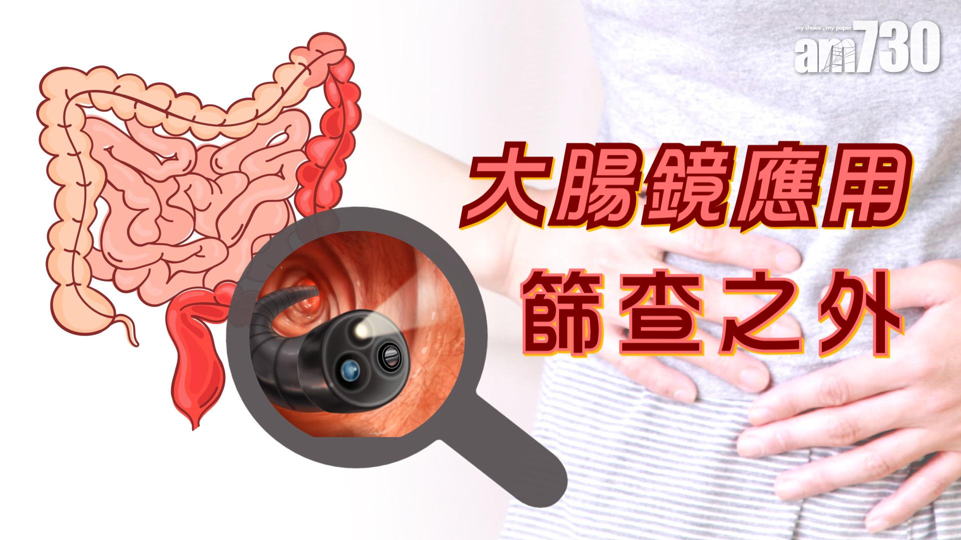大腸鏡應用 篩查之外