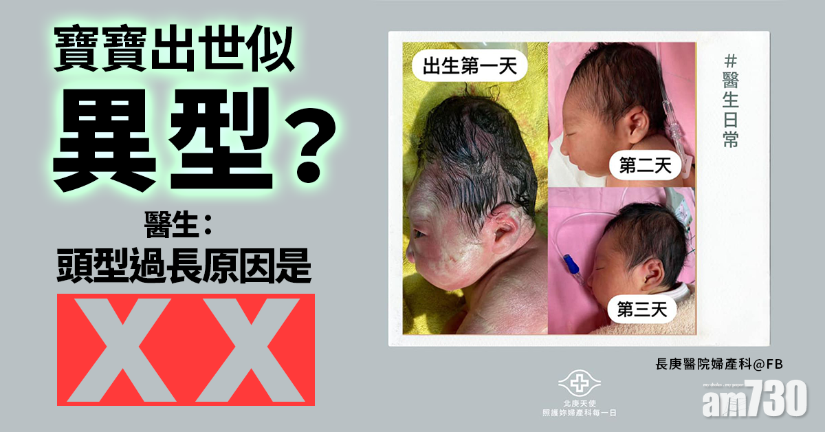 寶寶出世頭型長到嚇親阿嫲 醫生解釋是這個原因 ?