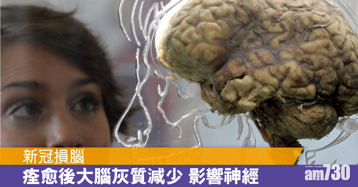新冠後遺症丨研究指接受氧氣治療或高燒 愈後大腦灰質減少 損神經影響情緒