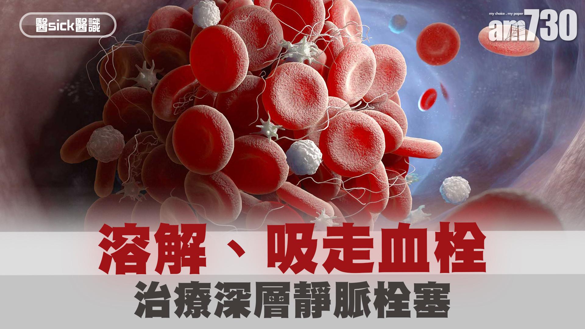 溶解、吸走血栓 治療深層靜脈栓塞