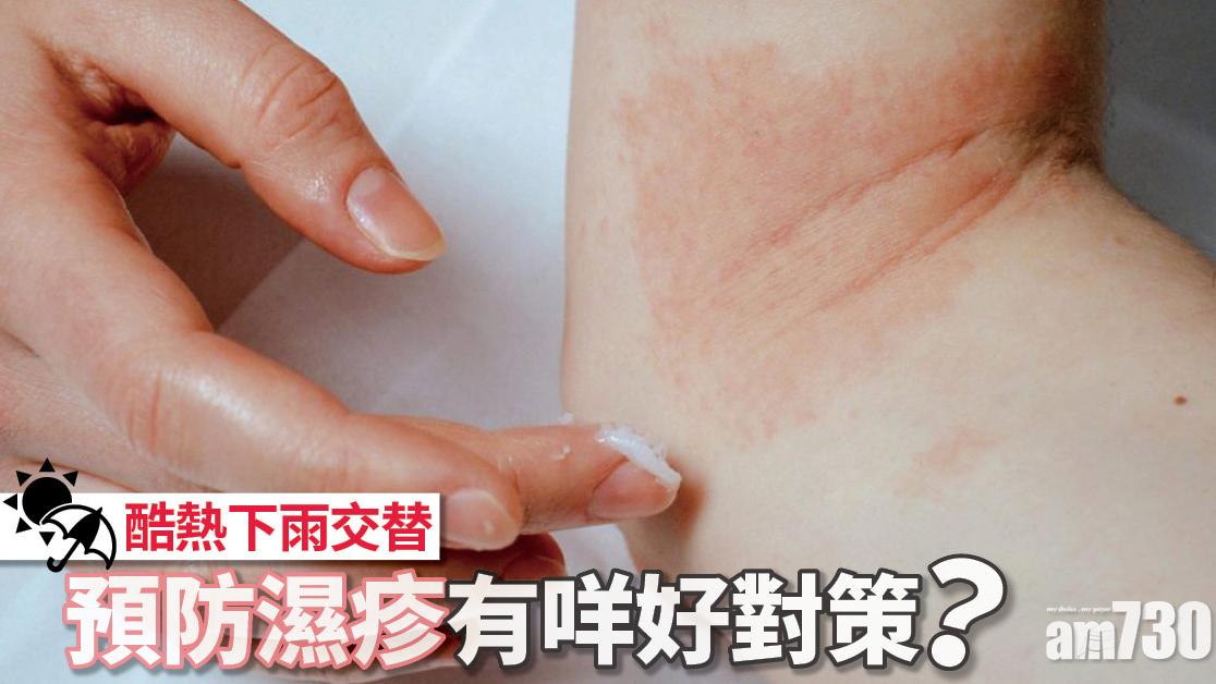 濕疹｜酷熱天氣晴雨交替　又濕又焗小心濕疹發作