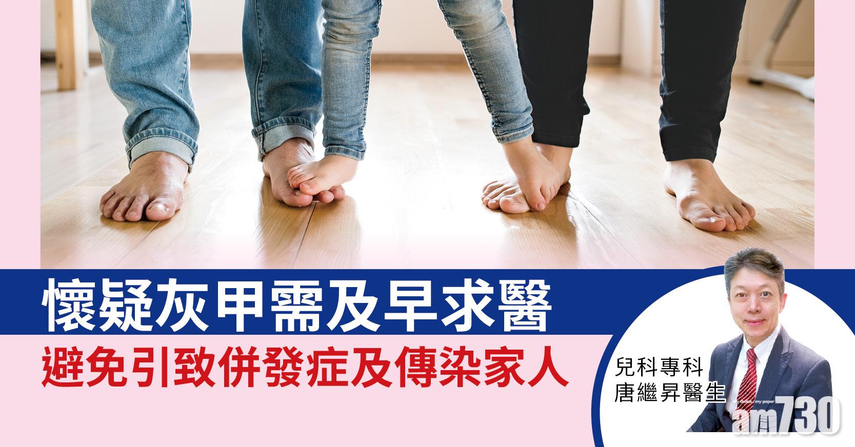 【健康佳】懷疑灰甲需及早求醫 避免引致併發症及傳染家人 