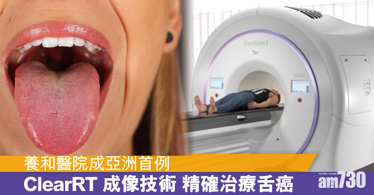 養和醫院採用ClearRT成像技術 精確治療舌癌 成亞洲首例