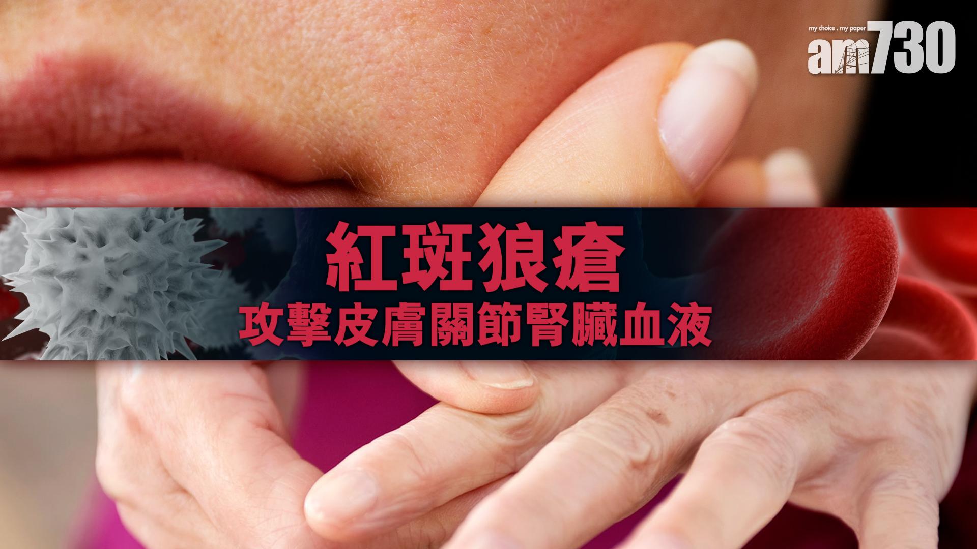 紅斑狼瘡 攻擊皮膚關節腎臟血液