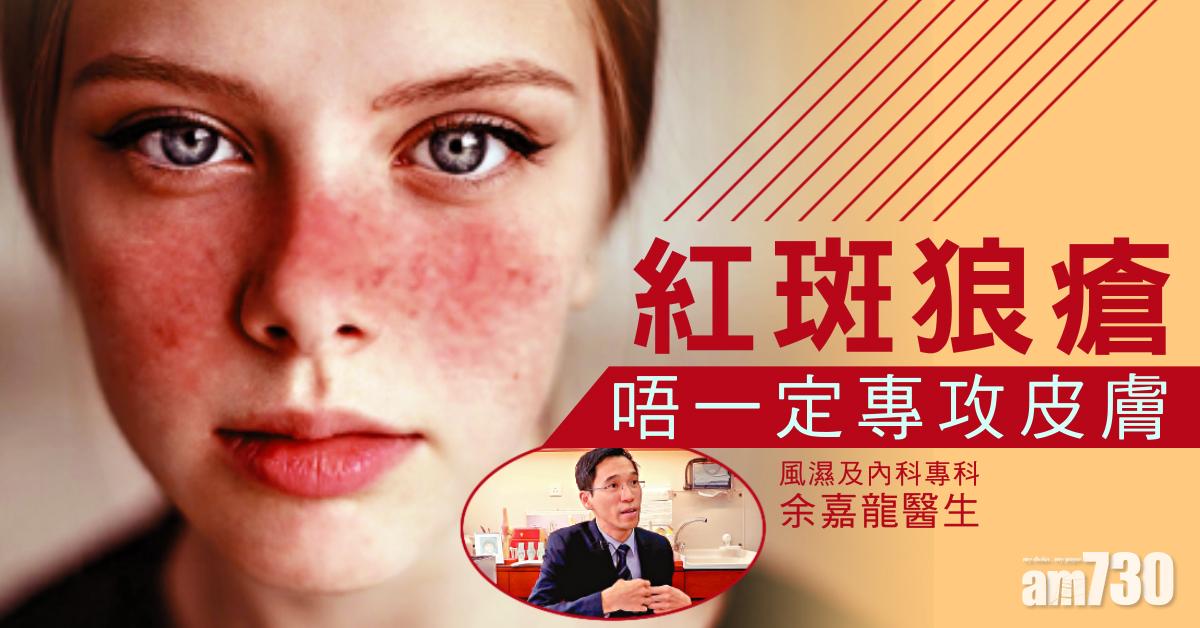 紅斑狼瘡 專攻年輕女性