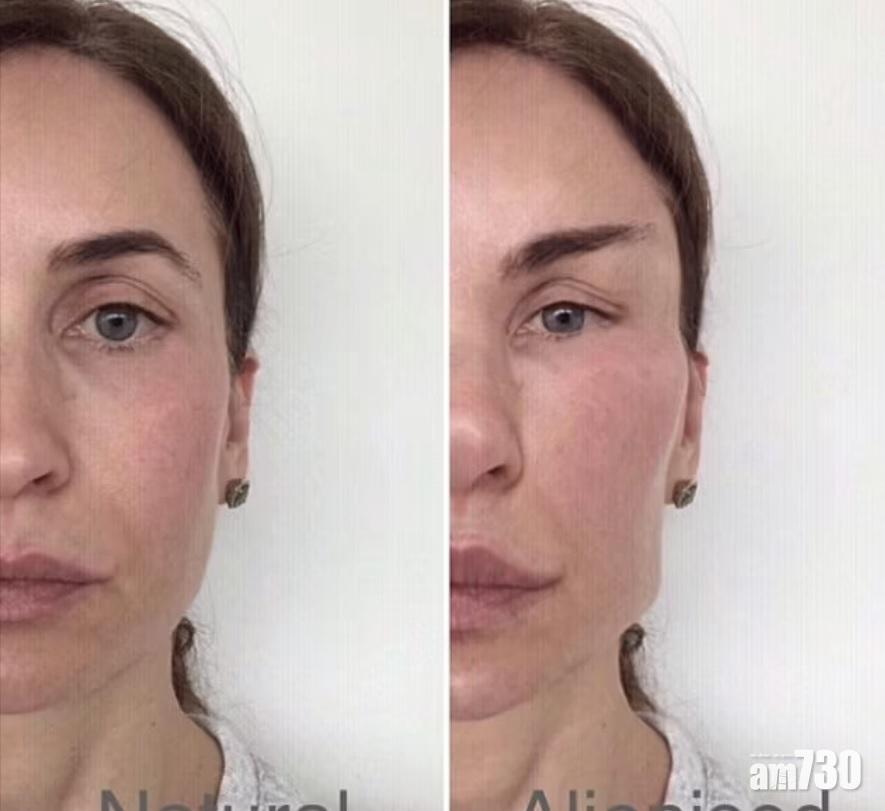 整容歪風｜英國貪靚族驚現「異形臉」 良心整容醫生痛陳行內弊端