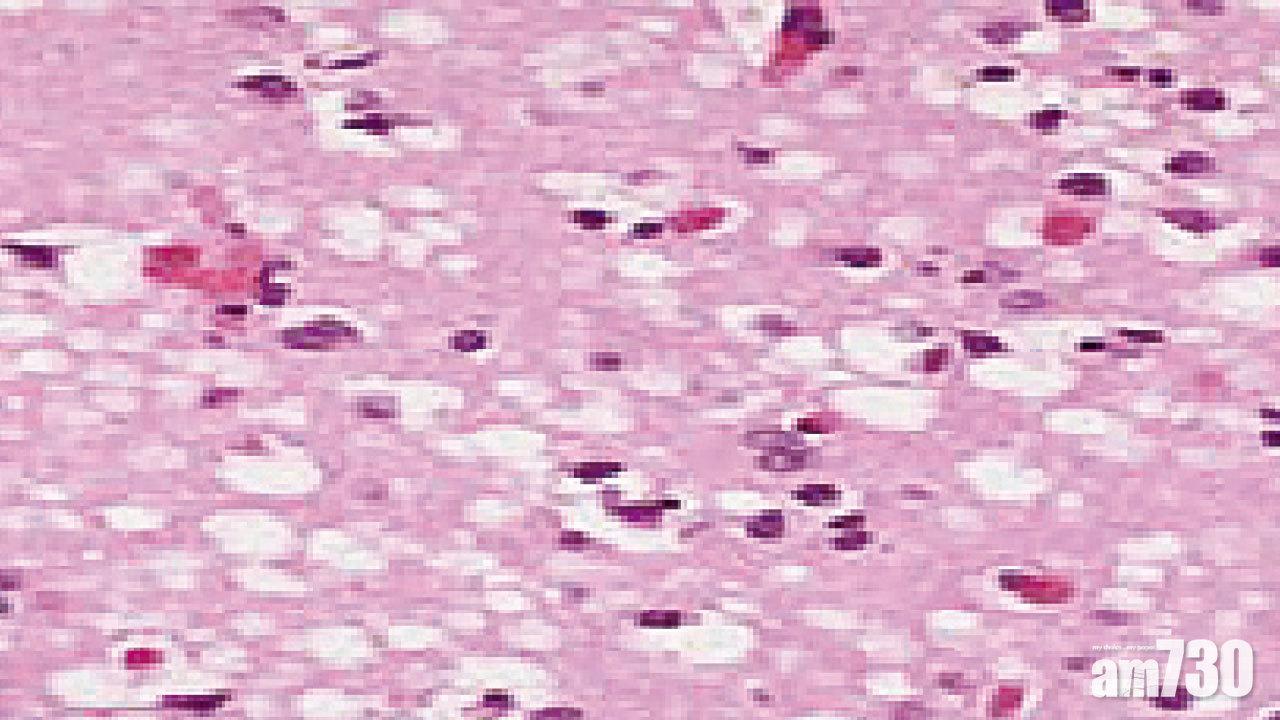 瘋牛症可傳人 腦部變海綿 克雅二氏症無藥可治