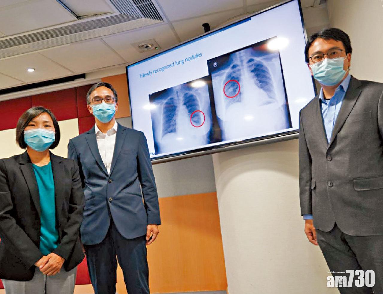 病人肺片逐張審視平均花6日 醫管局引AI分析流程減六成