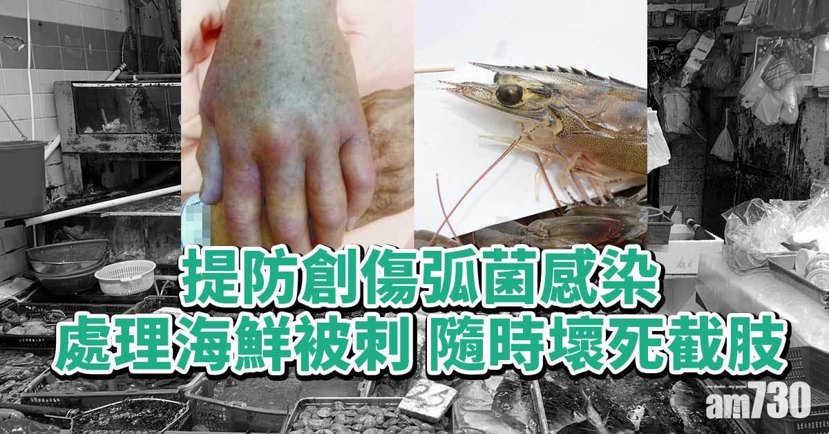 創傷弧菌感染丨處理海鮮誤被刺 隨時食肉菌感染 壞死要截肢