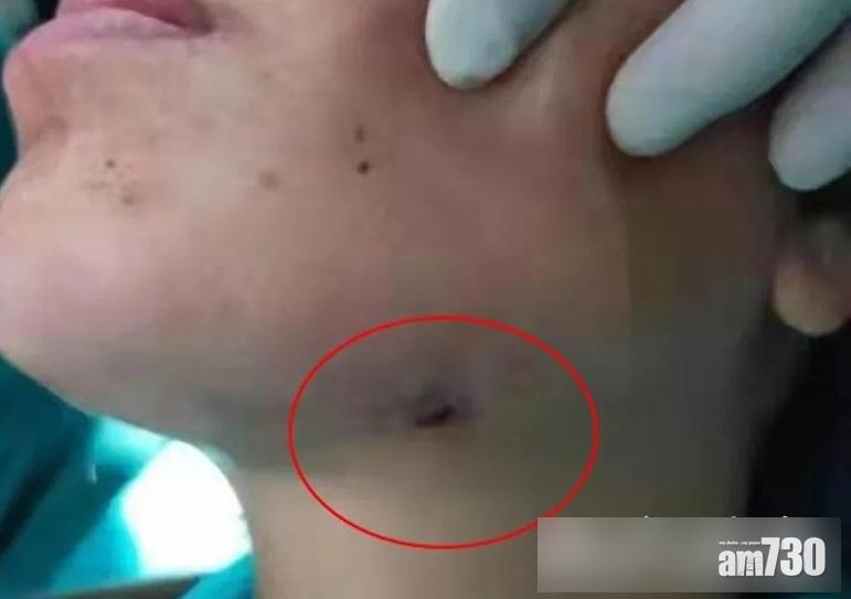 智慧齒發炎幾年死忍 江蘇女臉穿流膿口腔惡臭