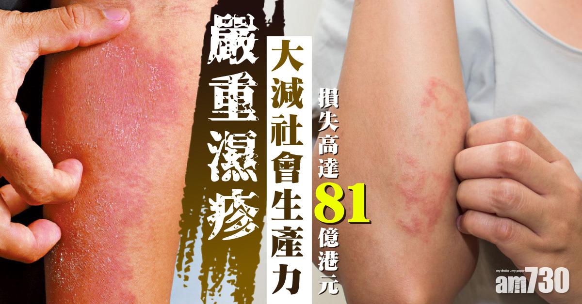 嚴重濕疹 大減社會生產力