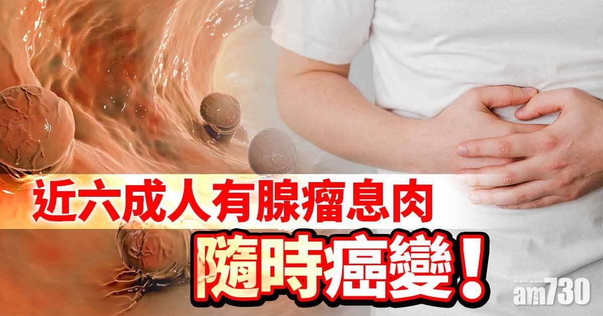 近六成人有腺瘤息肉 隨時癌變